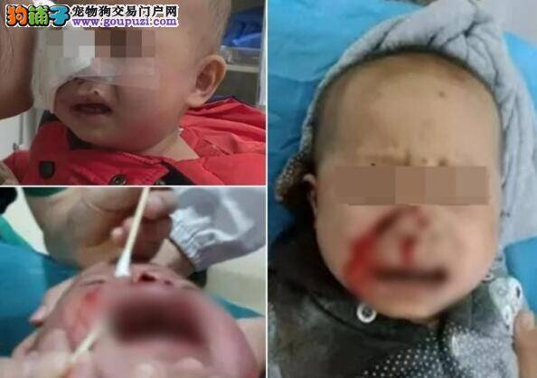 惨!湖南1岁男婴被狗咬 脸部重创恐毁容