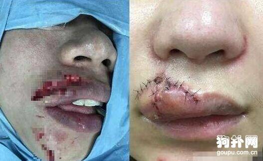 宠主强行要和狗狗亲亲，惹怒狗狗，嘴巴被咬烂